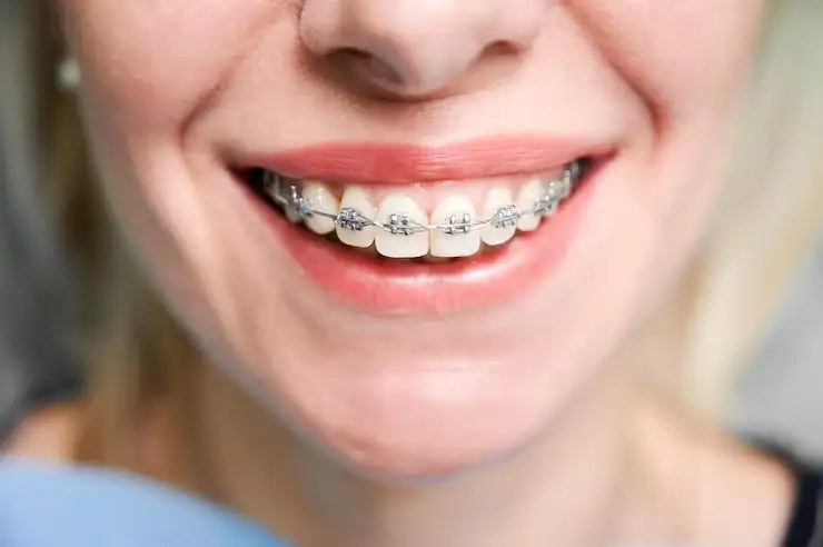 Closeup clear braces in ___all_locations___